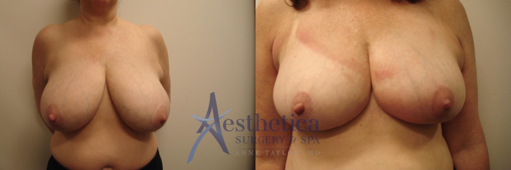Breast Reduction Case 705 Before & After Front | Columbus, OH | Aesthetica Surgery & Spa
