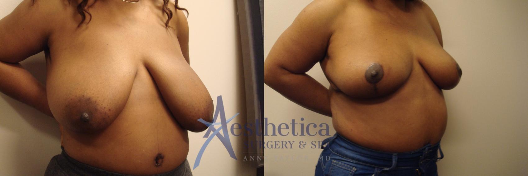 Breast Reduction Case 709 Before & After Right Oblique | Columbus, OH | Aesthetica Surgery & Spa