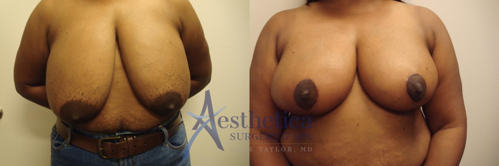 Breast Reduction Case 719 Before & After Front | Columbus, OH | Aesthetica Surgery & Spa