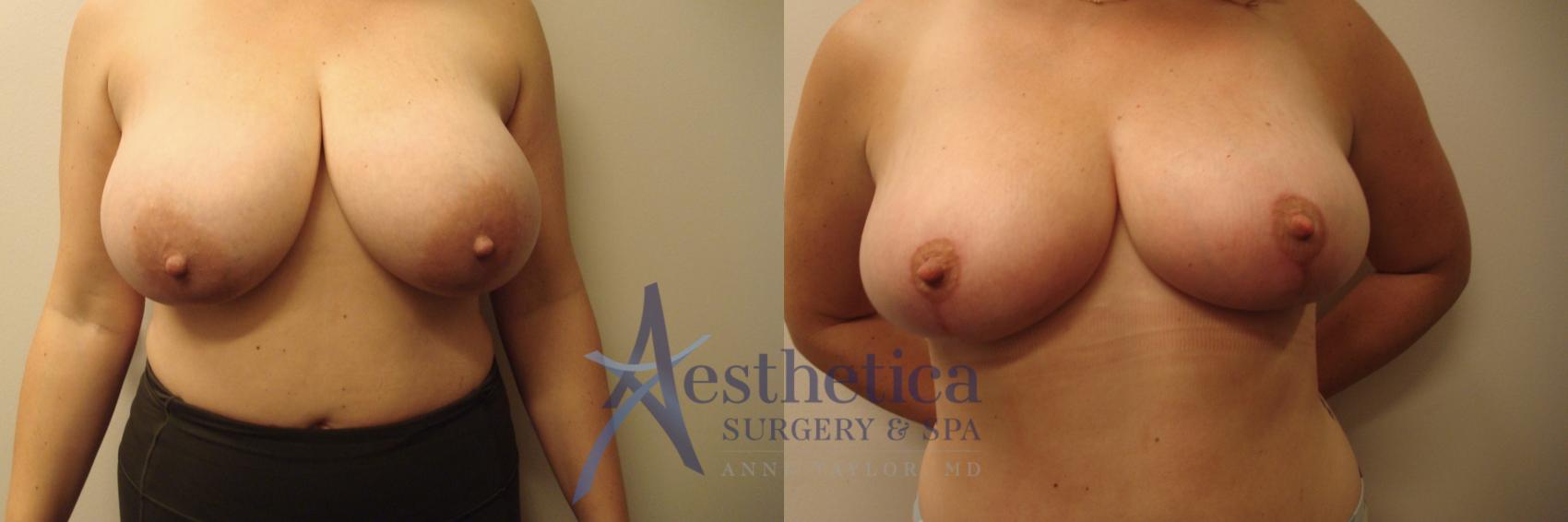 Breast Reduction Case 728 Before & After Front | Columbus, OH | Aesthetica Surgery & Spa