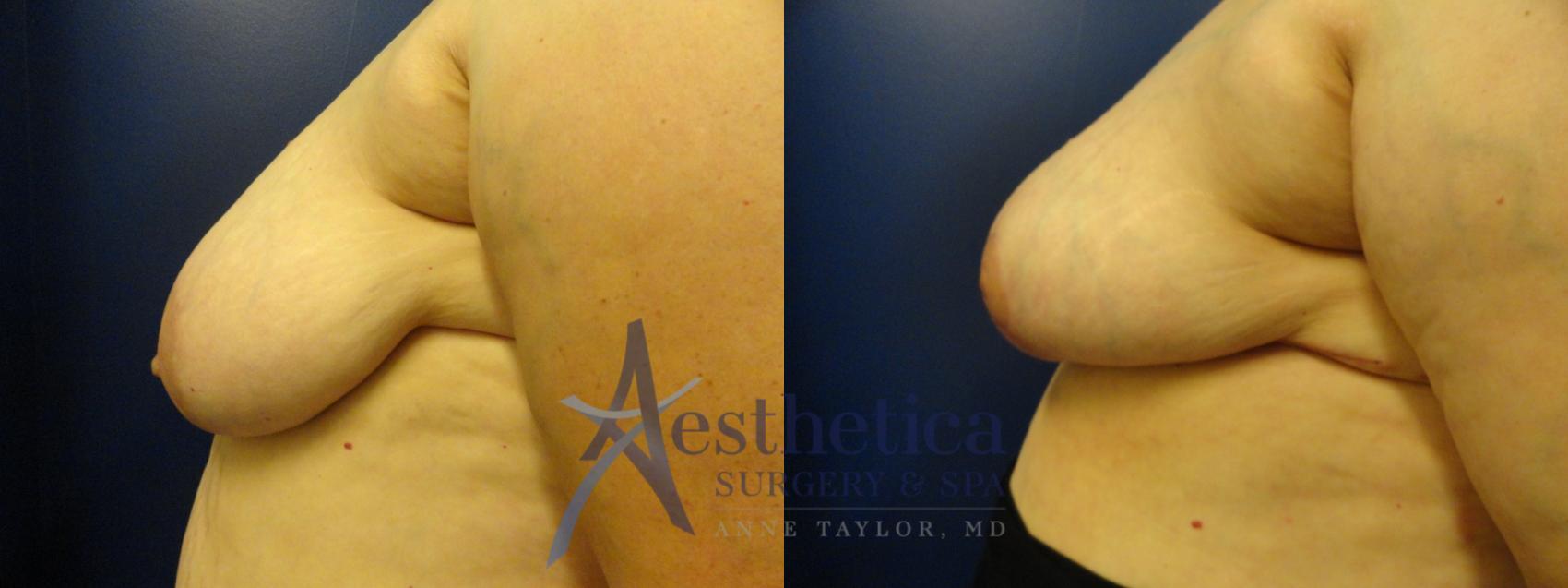 Breast Reduction Case 74 Before & After View #1 | Columbus, OH | Aesthetica Surgery & Spa