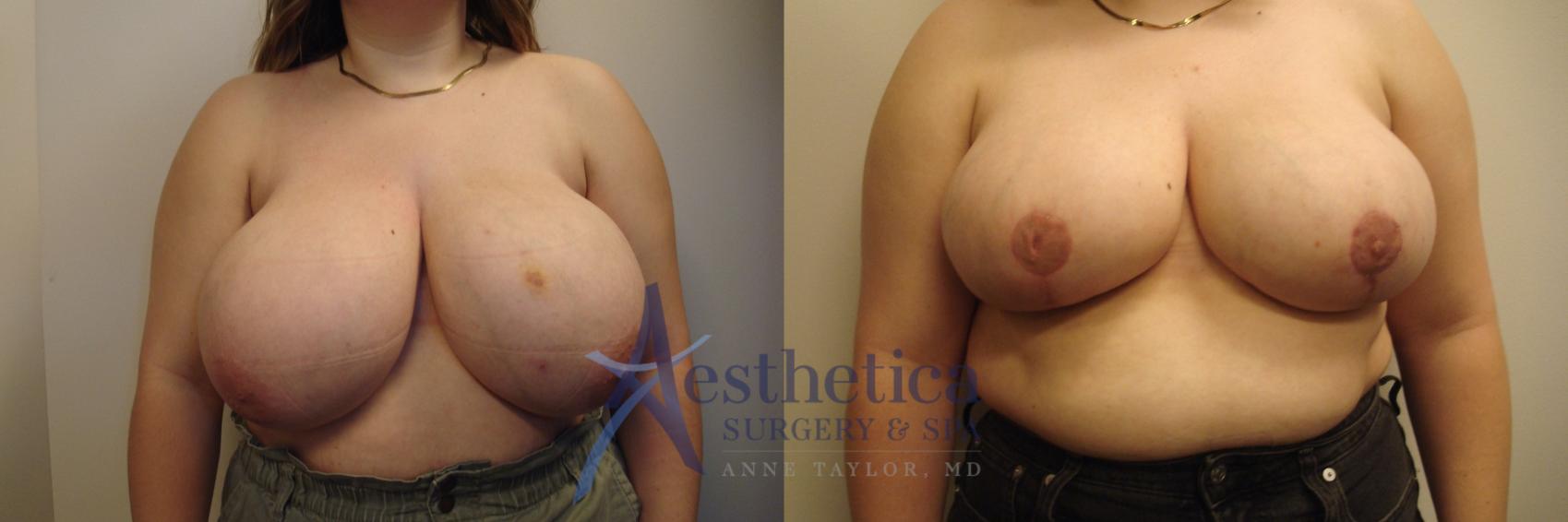 Breast Reduction Case 742 Before & After Front | Columbus, OH | Aesthetica Surgery & Spa