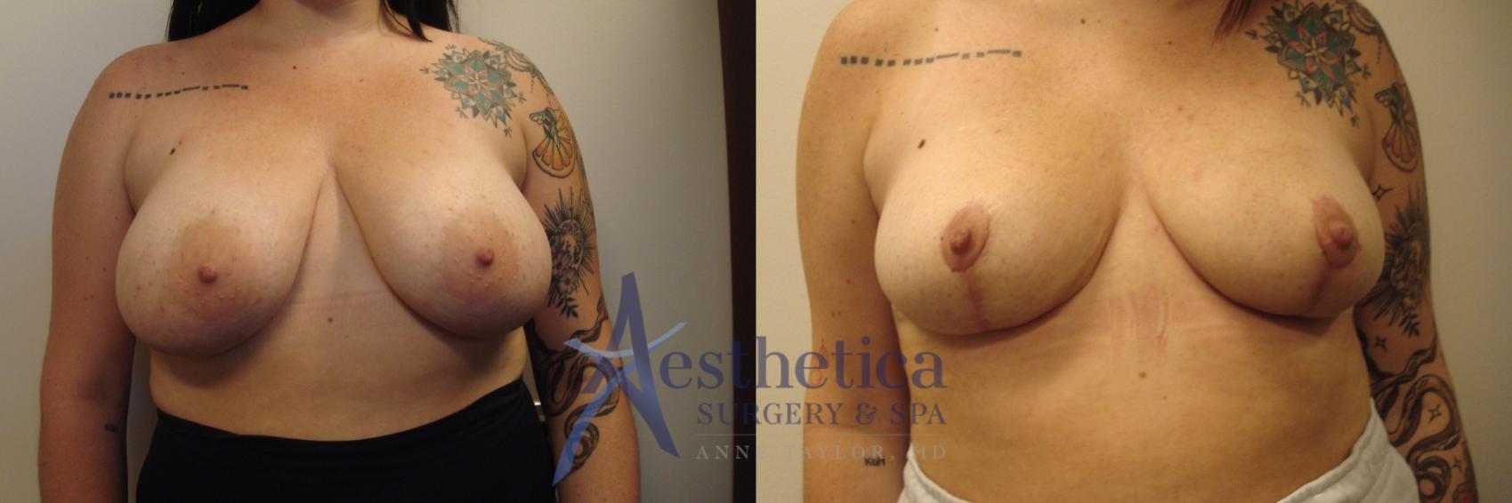 Breast Reduction Case 743 Before & After Front | Columbus, OH | Aesthetica Surgery & Spa