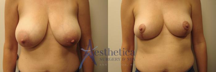 Breast Reduction Case 755 Before & After Front | Columbus, OH | Aesthetica Surgery & Spa