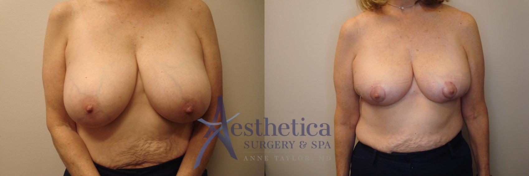 Breast Reduction Case 760 Before & After Front | Columbus, OH | Aesthetica Surgery & Spa