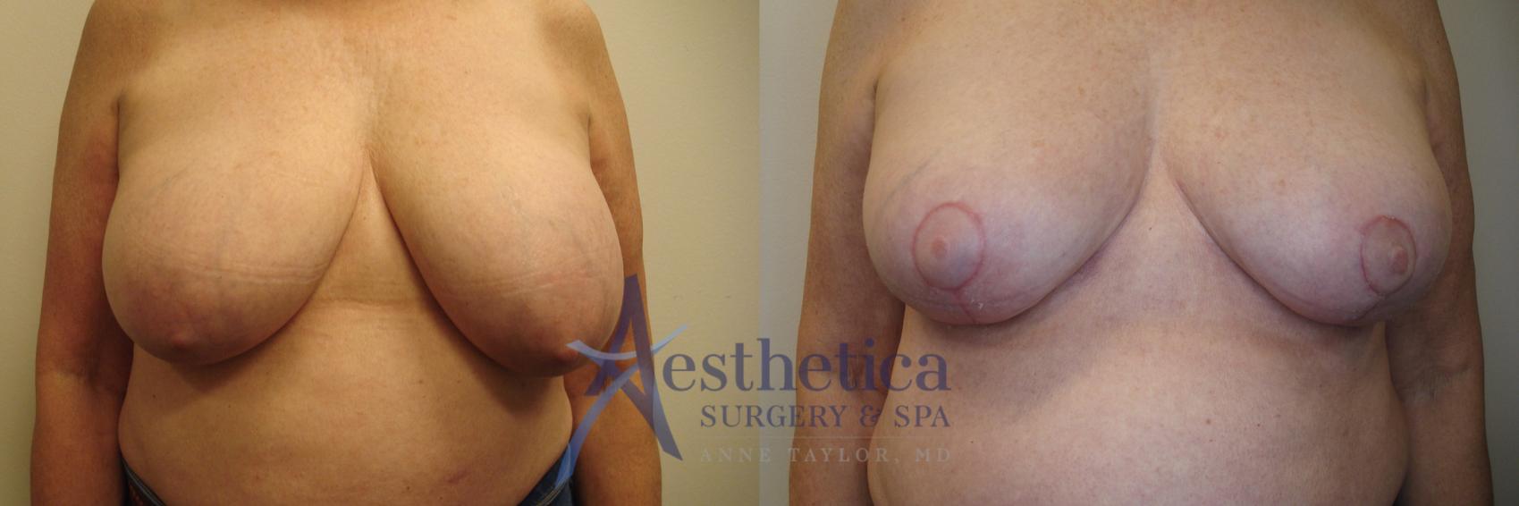 Breast Reduction Case 762 Before & After Front | Columbus, OH | Aesthetica Surgery & Spa