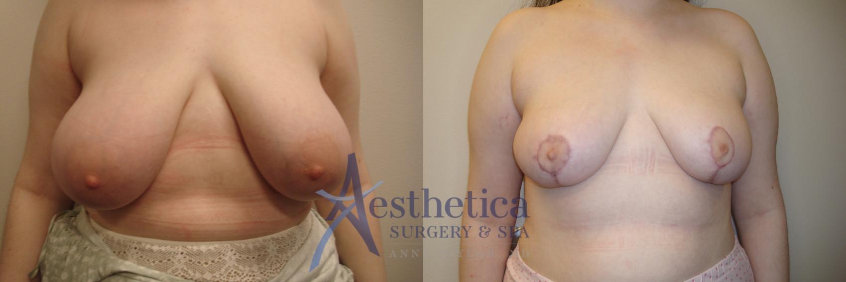 Breast Reduction Case 773 Before & After Front | Columbus, OH | Aesthetica Surgery & Spa