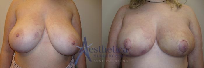 Breast Reduction Case 783 Before & After Front | Columbus, OH | Aesthetica Surgery & Spa