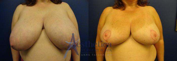 Breast Reduction Case 79 Before & After View #1 | Columbus, OH | Aesthetica Surgery & Spa