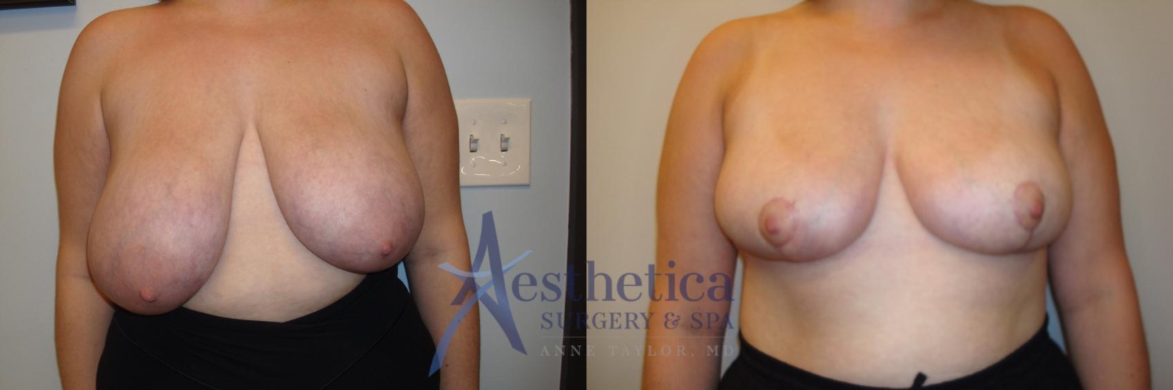 Breast Reduction Case 804 Before & After Front | Columbus, OH | Aesthetica Surgery & Spa