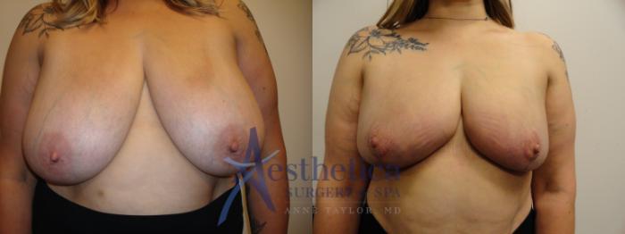 Breast Reduction Case 826 Before & After Front | Columbus, OH | Aesthetica Surgery & Spa