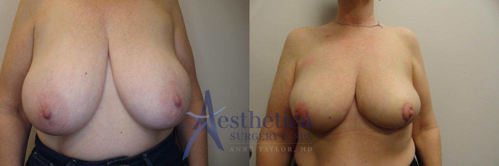 Breast Reduction Case 834 Before & After Front | Columbus, OH | Aesthetica Surgery & Spa