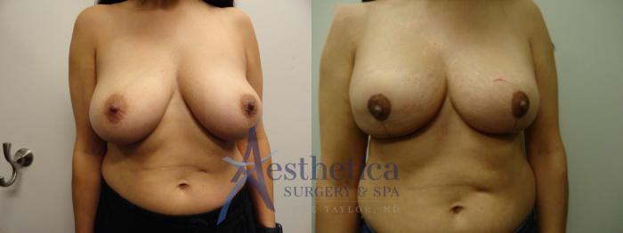 Breast Reduction Case 874 Before & After Front | Columbus, OH | Aesthetica Surgery & Spa
