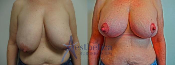 Breast Reduction Case 897 Before & After Front | Columbus, OH | Aesthetica Surgery & Spa