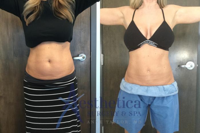 Coolsculpting Case 551 Before & After Front | Columbus, OH | Aesthetica Surgery & Spa