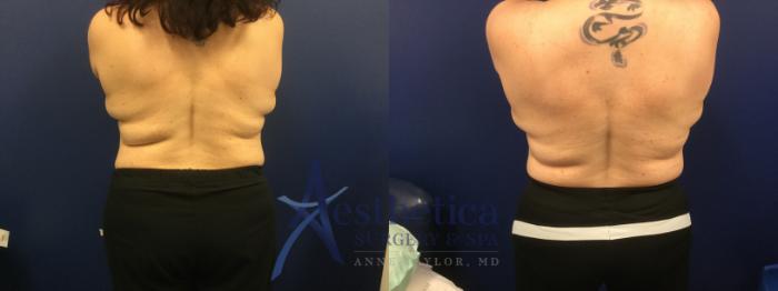 Coolsculpting Case 572 Before & After Back | Columbus, OH | Aesthetica Surgery & Spa