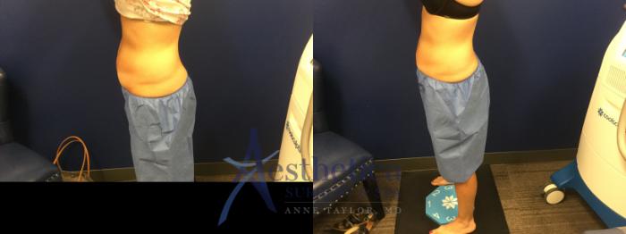 Coolsculpting Case 573 Before & After Left Side | Columbus, OH | Aesthetica Surgery & Spa