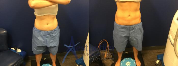 Coolsculpting Case 574 Before & After Front | Columbus, OH | Aesthetica Surgery & Spa