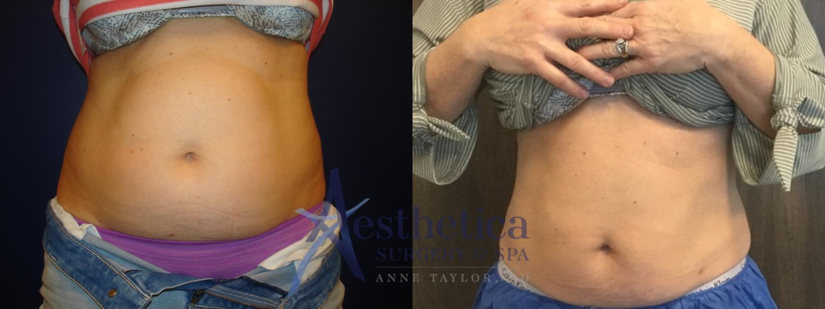 Coolsculpting Case 575 Before & After Front | Columbus, OH | Aesthetica Surgery & Spa