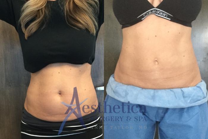 Coolsculpting Case 576 Before & After Front | Columbus, OH | Aesthetica Surgery & Spa