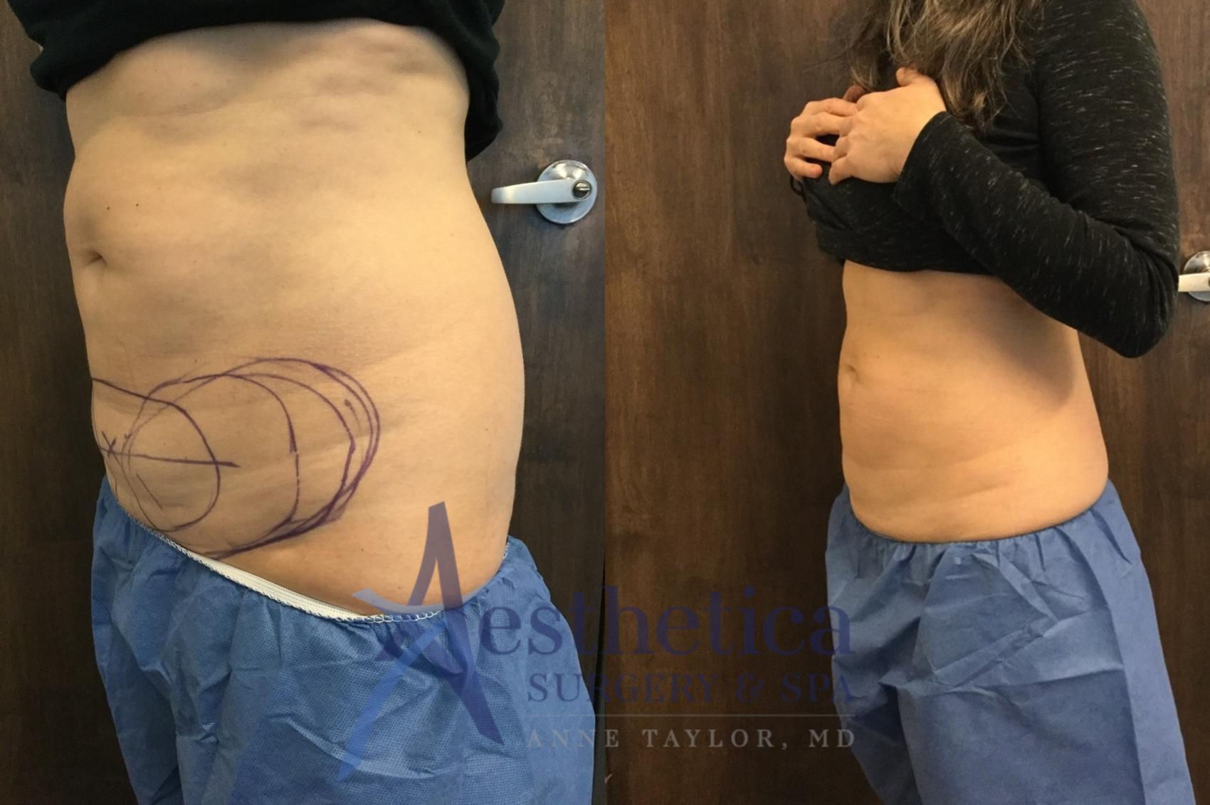 Coolsculpting Case 577 Before & After Left Side | Worthington, OH | Aesthetica Surgery & Spa