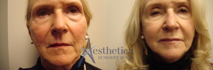 Facelift Case 432 Before & After View #1 | Columbus, OH | Aesthetica Surgery & Spa