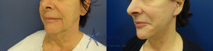 Facelift Case 44 Before & After View #1 | Columbus, OH | Aesthetica Surgery & Spa