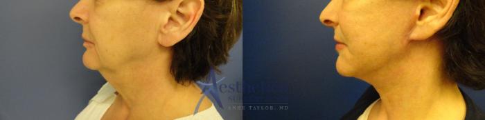 Facelift Case 44 Before & After View #2 | Columbus, OH | Aesthetica Surgery & Spa