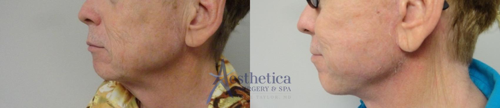 Facelift Case 45 Before & After View #1 | Worthington, OH | Aesthetica Surgery & Spa