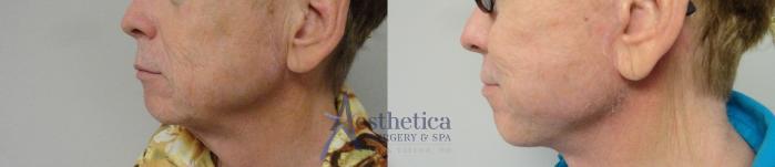 Facelift Case 45 Before & After View #1 | Columbus, OH | Aesthetica Surgery & Spa