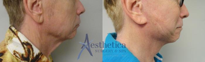 Facelift Case 45 Before & After View #2 | Columbus, OH | Aesthetica Surgery & Spa