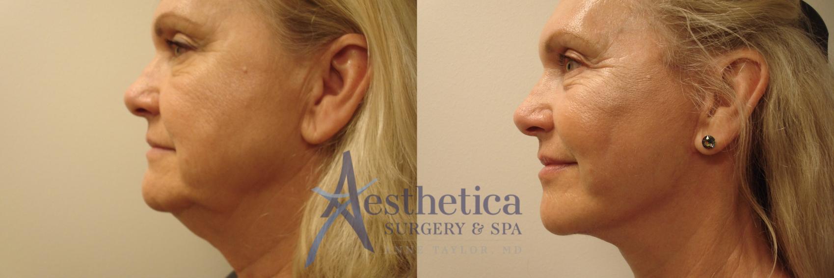 Facelift Case 492 Before & After Left Side | Worthington, OH | Aesthetica Surgery & Spa
