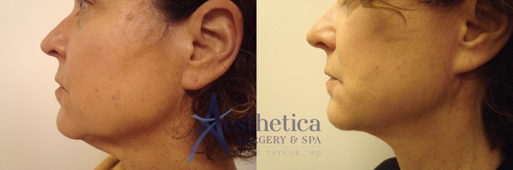 Facelift Case 494 Before & After Right Side | Worthington, OH | Aesthetica Surgery & Spa