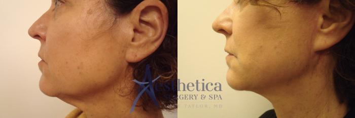 Facelift Case 494 Before & After Right Side | Columbus, OH | Aesthetica Surgery & Spa