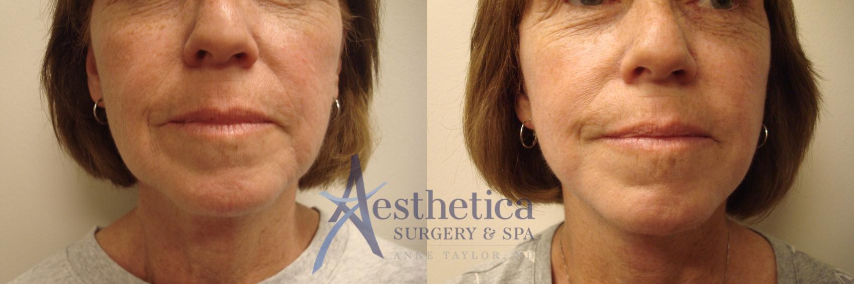 Facelift Case 503 Before & After Front | Columbus, OH | Aesthetica Surgery & Spa