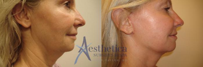 Facelift Case 520 Before & After Right Side | Worthington, OH | Aesthetica Surgery & Spa