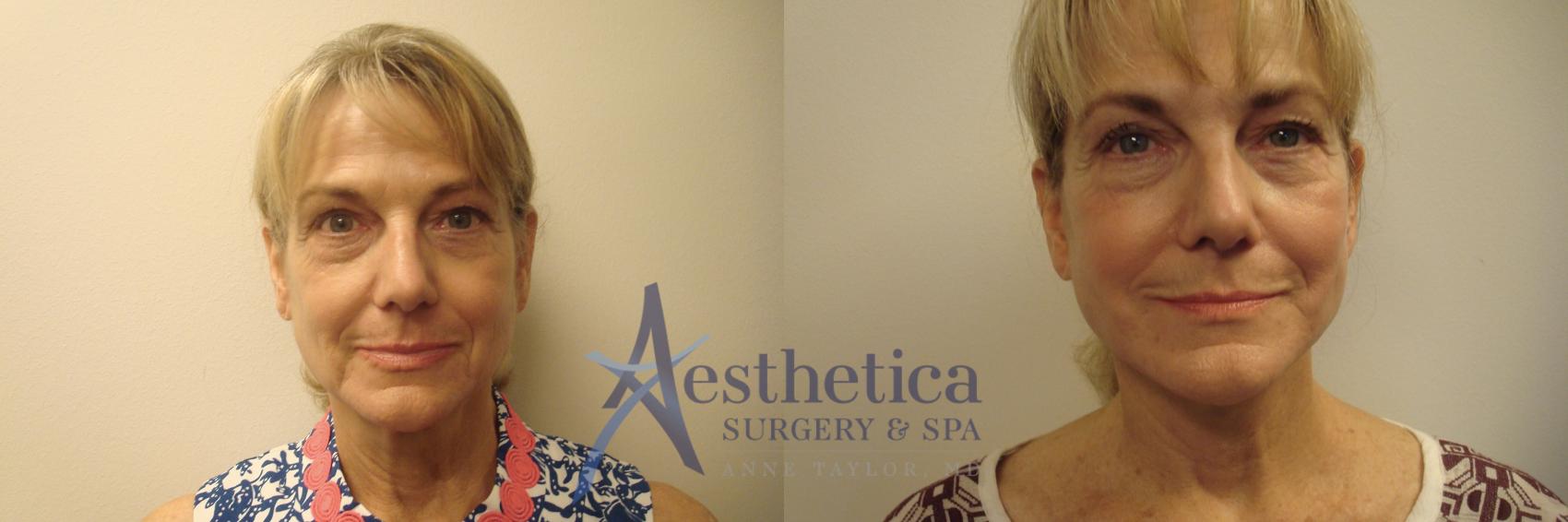 Facelift Case 529 Before & After Front | Worthington, OH | Aesthetica Surgery & Spa