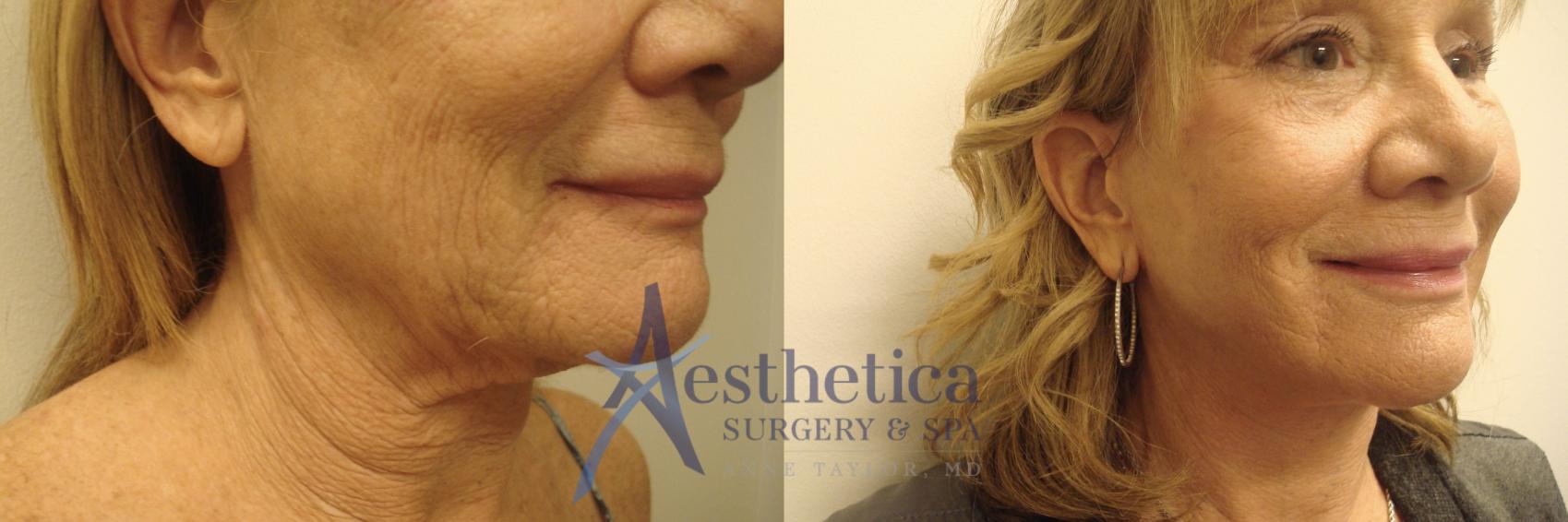Facelift Case 539 Before & After Right Oblique | Worthington, OH | Aesthetica Surgery & Spa