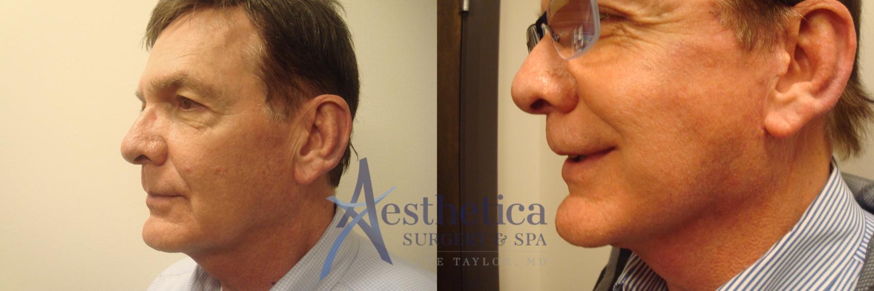 Facelift Case 555 Before & After Left Side | Worthington, OH | Aesthetica Surgery & Spa