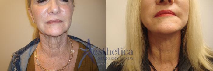 Facelift Case 557 Before & After Front | Columbus, OH | Aesthetica Surgery & Spa