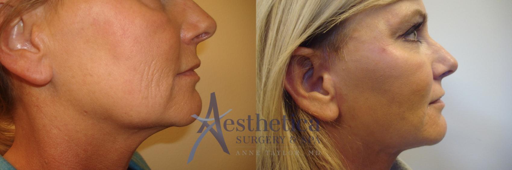 Facelift Case 558 Before & After Right Side | Worthington, OH | Aesthetica Surgery & Spa