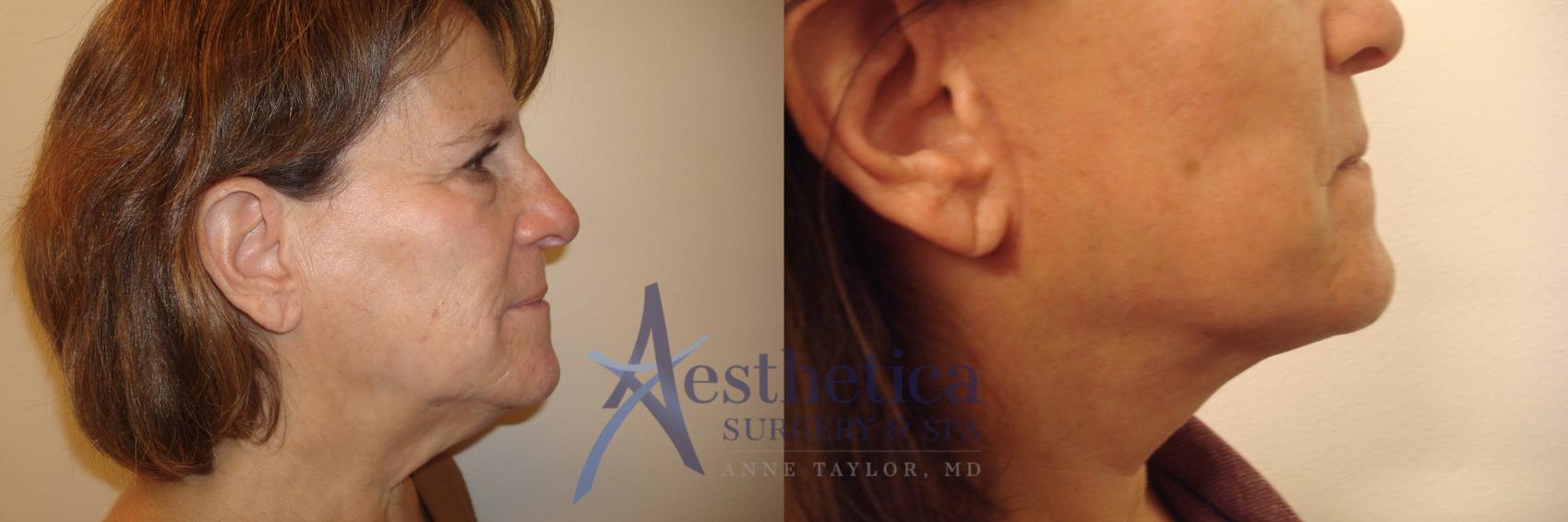 Facelift Case 559 Before & After Right Side | Worthington, OH | Aesthetica Surgery & Spa