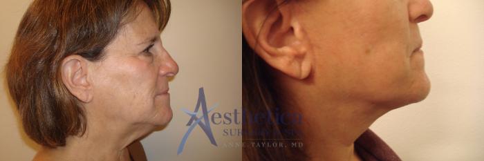 Facelift Case 559 Before & After Right Side | Columbus, OH | Aesthetica Surgery & Spa