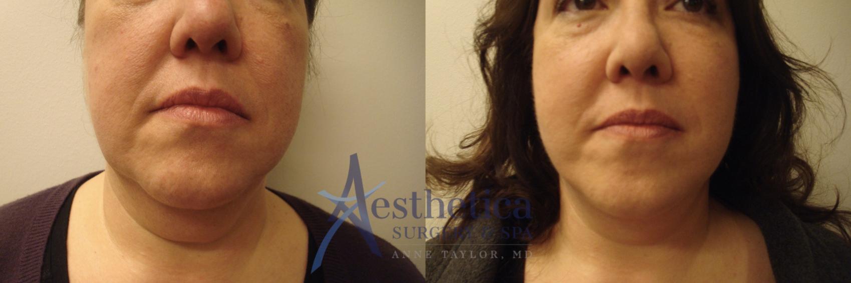 Facelift Case 562 Before & After Front | Columbus, OH | Aesthetica Surgery & Spa