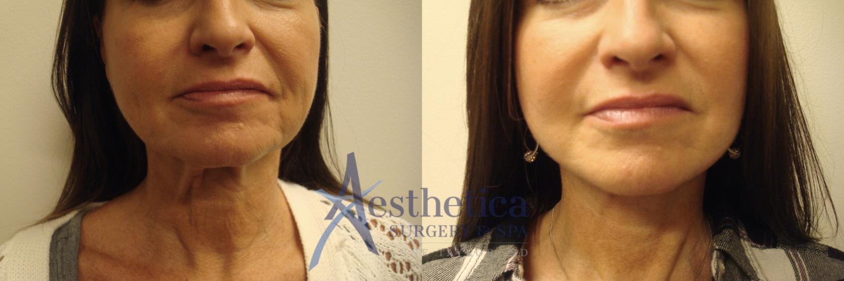 Facelift Case 563 Before & After Front | Worthington, OH | Aesthetica Surgery & Spa