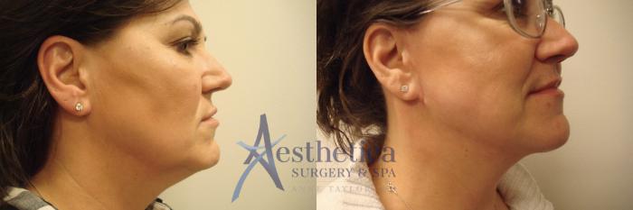 Facelift Case 567 Before & After Right Side | Columbus, OH | Aesthetica Surgery & Spa