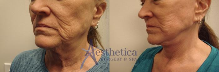 Facelift Case 581 Before & After Left Oblique | Columbus, OH | Aesthetica Surgery & Spa