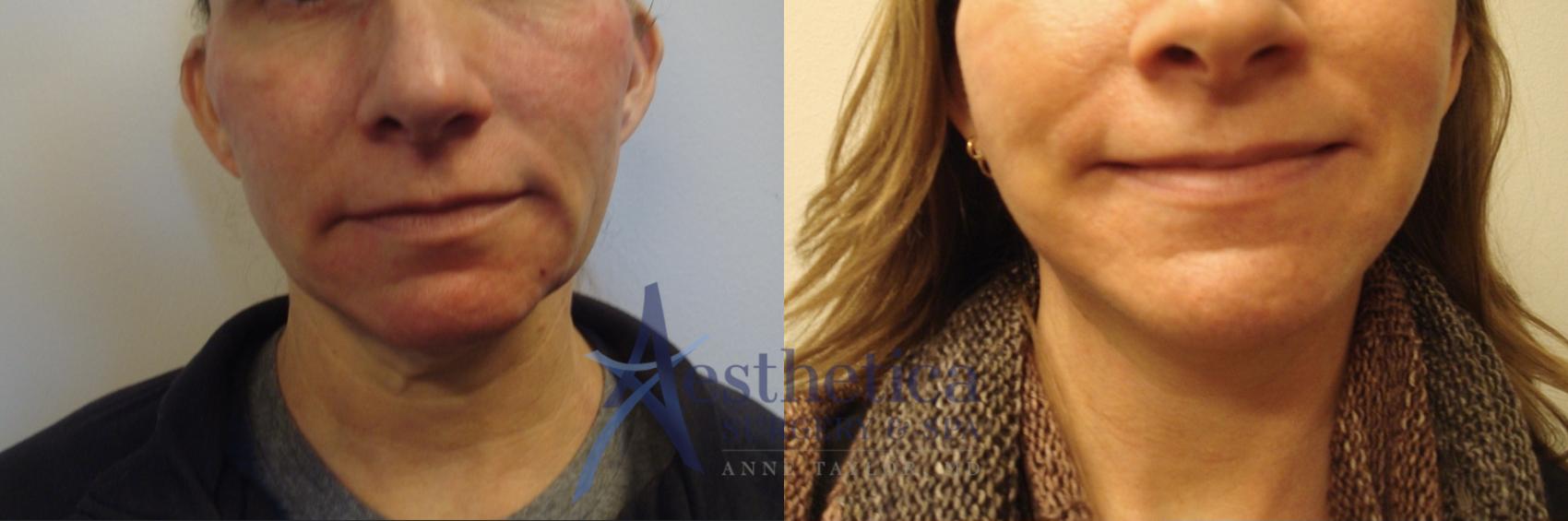 Facelift Case 584 Before & After Front | Columbus, OH | Aesthetica Surgery & Spa