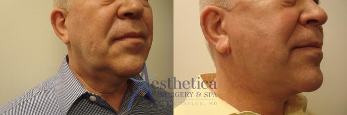Facelift Case 586 Before & After Right Side | Columbus, OH | Aesthetica Surgery & Spa