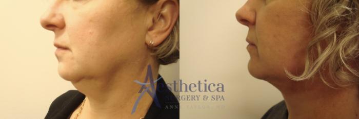Facelift Case 594 Before & After Left Side | Columbus, OH | Aesthetica Surgery & Spa